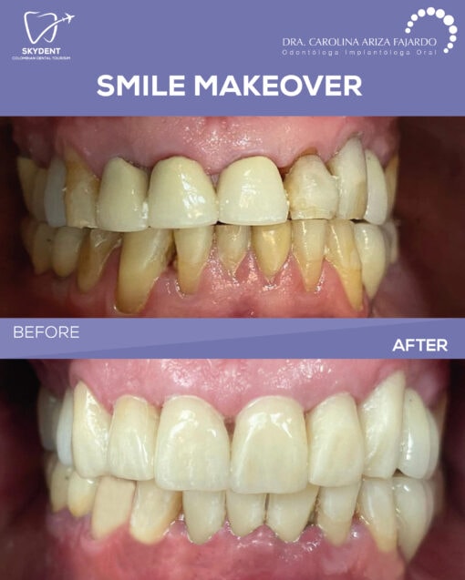 Smile Makeover Before & After — SkyDent Colombia