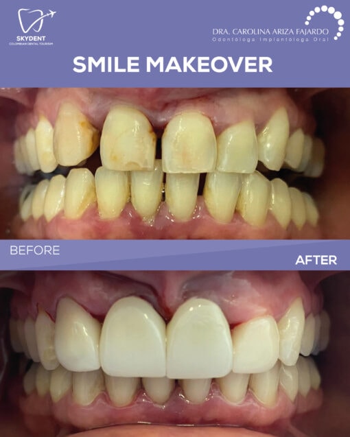 Smile Makeover Before & After — SkyDent Colombia