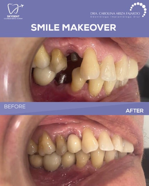 Smile Makeover Before & After — SkyDent Colombia