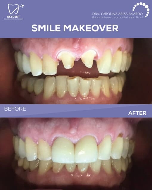 Smile Makeover Before & After — SkyDent Colombia
