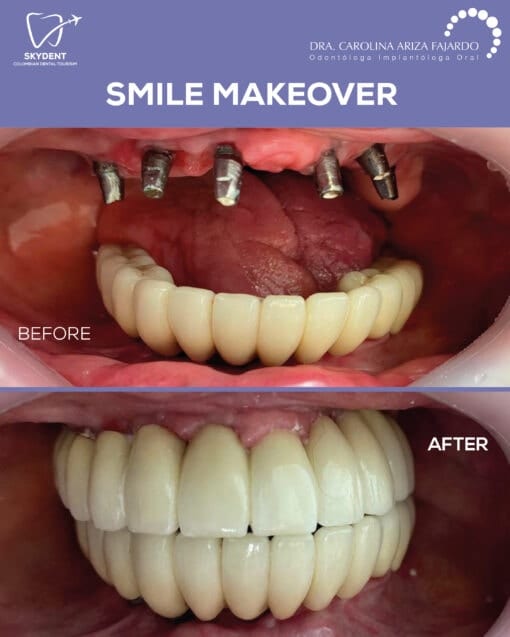 Smile Makeover Before & After — SkyDent Colombia
